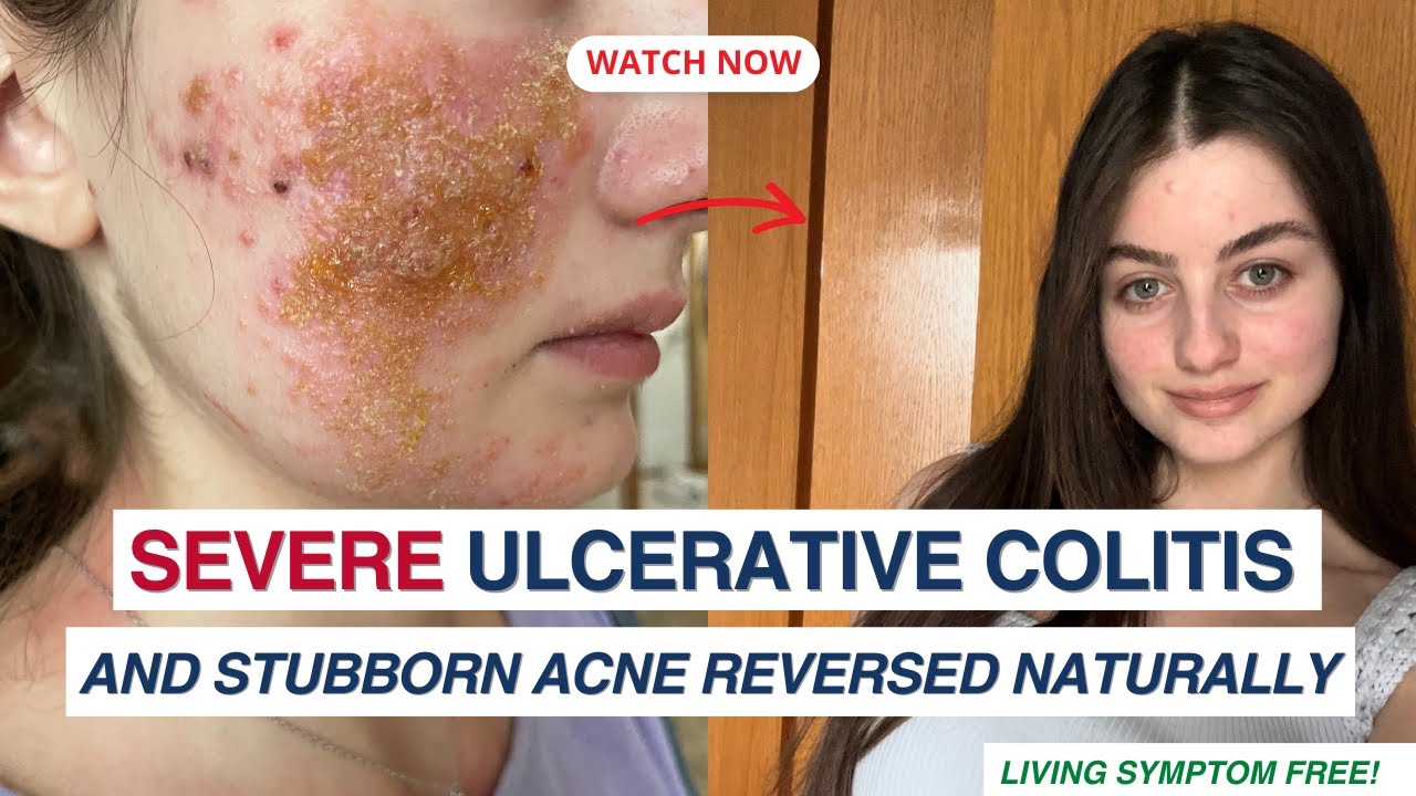 Briana Reversed Severe UC & Skin Issues With Natural Medicine!